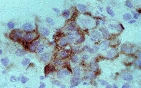 Plasmocitoma-1
