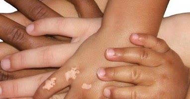 ¿El vitiligo es contagioso? 