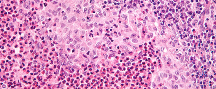 Histiocitosis de las células de Langerhans