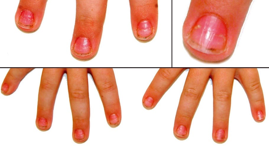 Psoriasis en las uñas