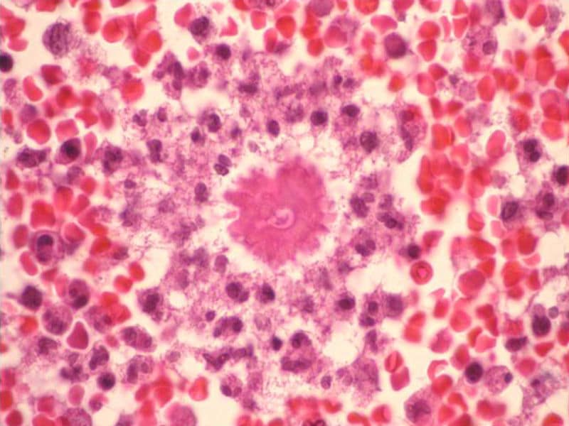micosis cutánea