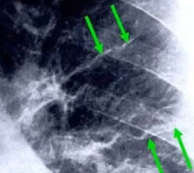 edema pulmonar agudo