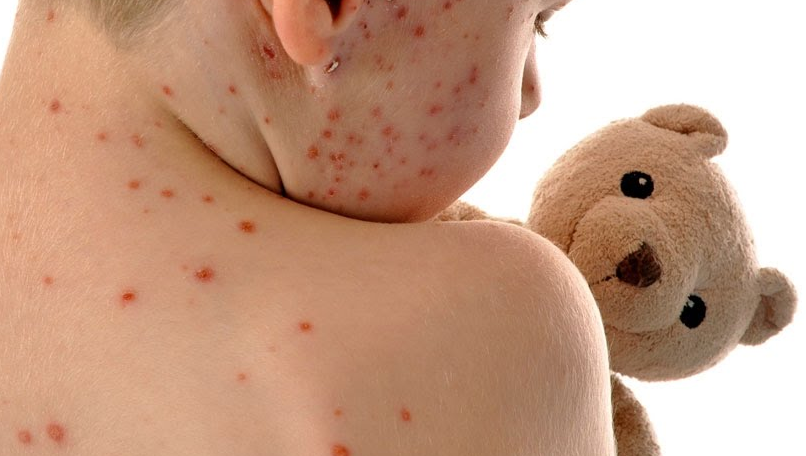 varicela en niños